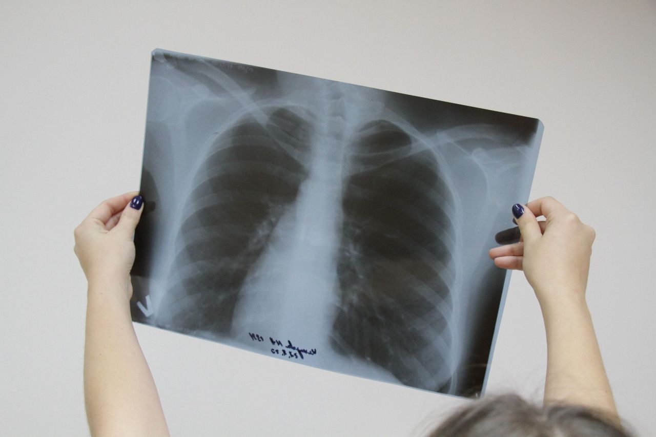 В Серовском горокруге за 10 месяцев 2020 года выявили меньше больных туберкулезом, чем в 2019