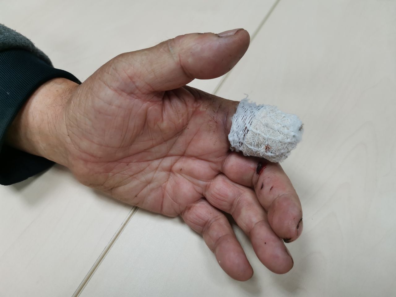 Серовчанин благодарит медиков за помощь. Мужчина случайно отрезал себе палец