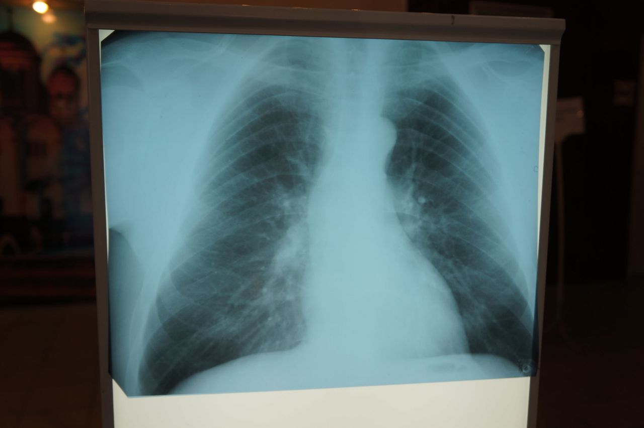 В Серове у воспитательницы детского сада нашли туберкулез