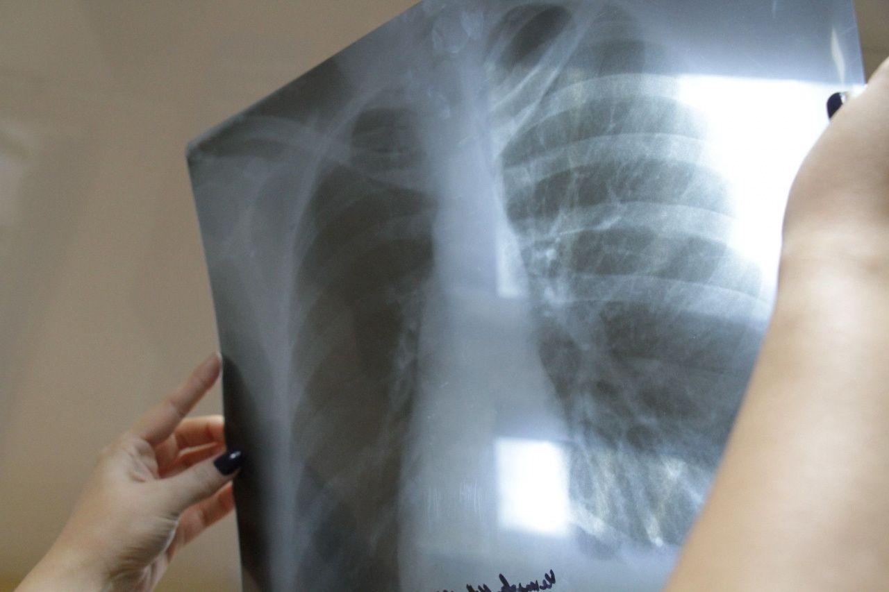 В Серовском горокруге за 10 месяцев выявлен 41 заболевший туберкулезом органов дыхания