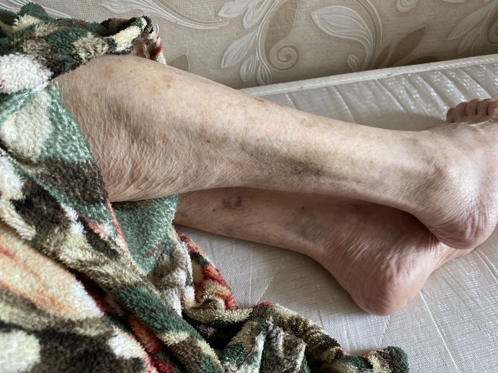 На ногах Тамары Нестеркиной проявились синяки. Фото: Анна Куприянова, "Глобус"