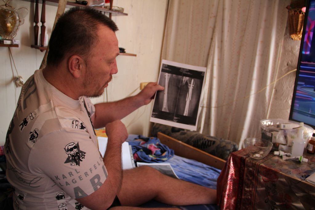 Александр Кушнерев показывает снимки установленных штифтов. Мужчина объяснил, что на снимке справа видно незакрепленный осколок кости. Фото: Мария Чекарова, "Глобус"