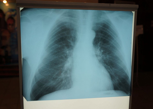 В Серове у воспитательницы детского сада нашли туберкулез