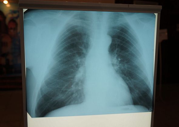В январе в Серове зарегистрировано 4 случая заболевания туберкулезом органов дыхания