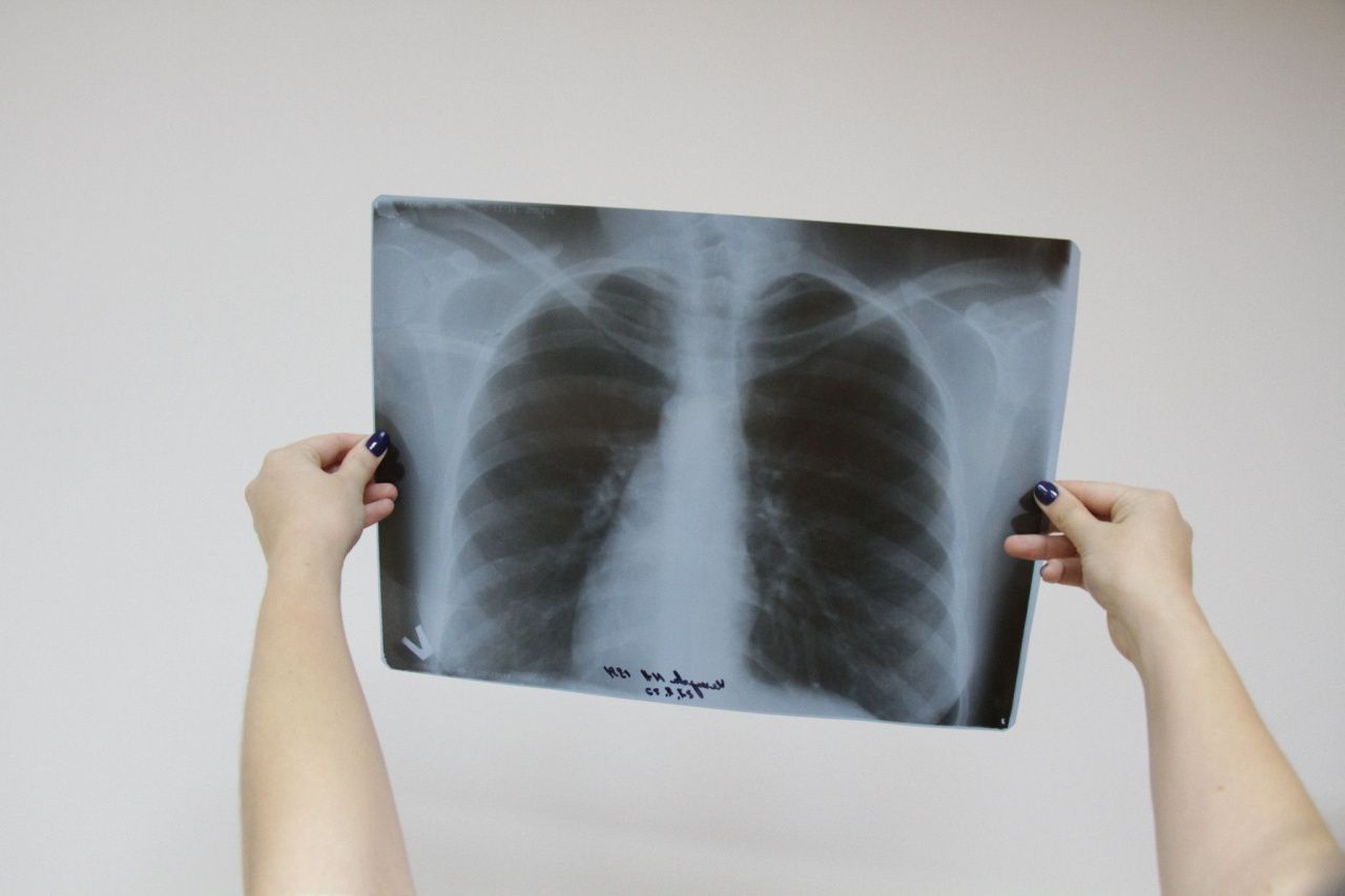 В Серовском горокруге с начала года выявили 30 случаев туберкулеза органов дыхания