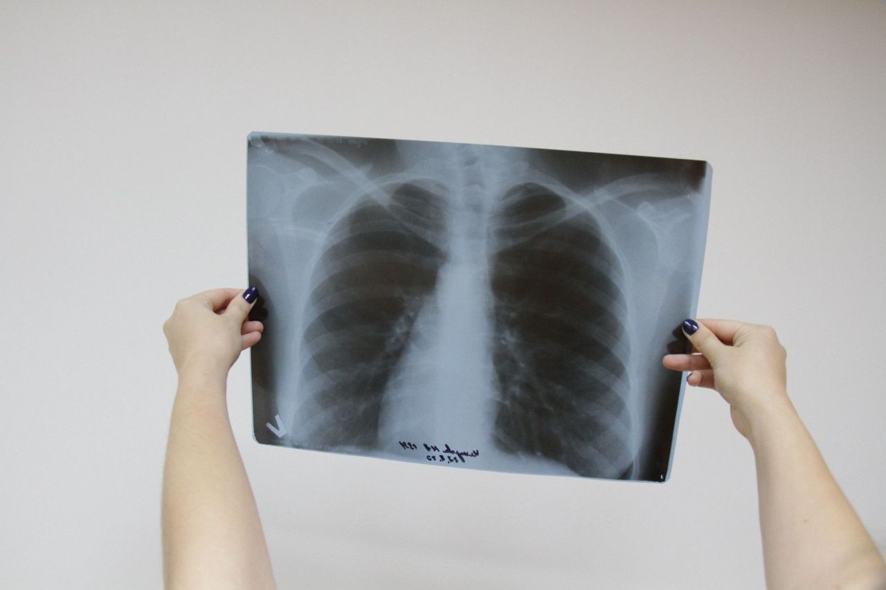 В Серовском горокруге за год зарегистрировано 47 случаев заболевания туберкулезом органов дыхания