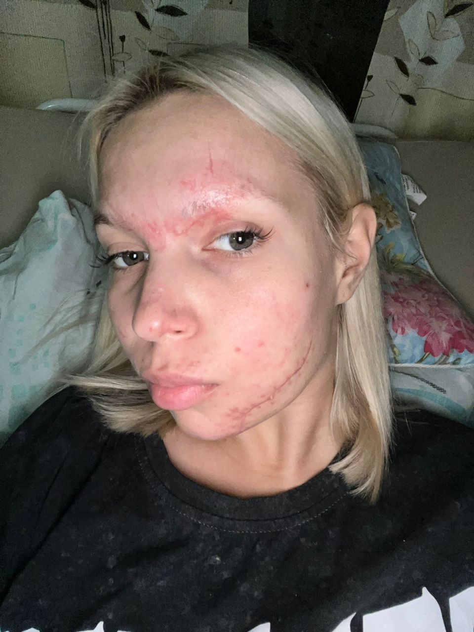 На операцию пострадавшей в ДТП серовчанке собрано 100 тысяч рублей. Сбор продолжается 