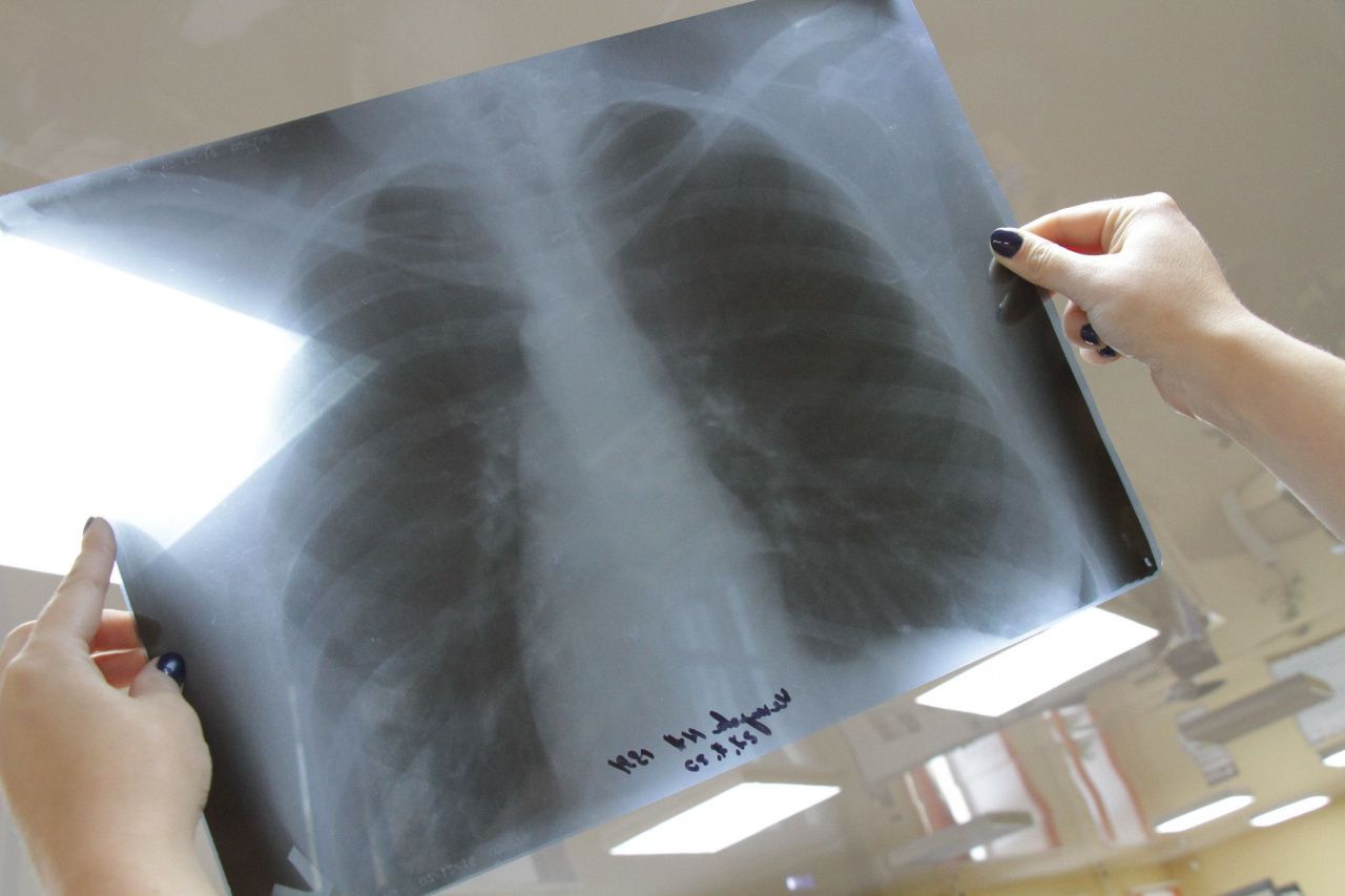 О заболеваемости туберкулезом в Серове, Сосьве и Гарях