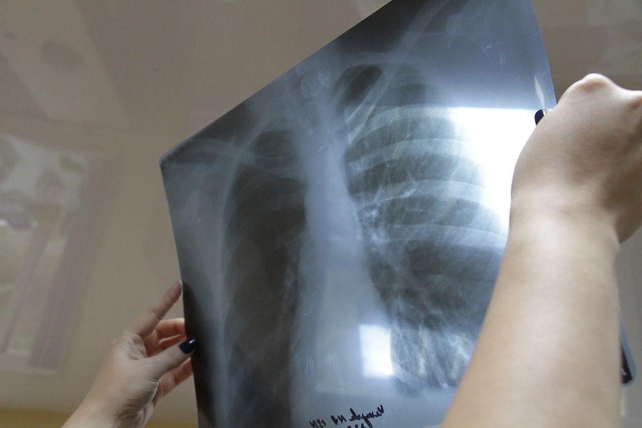 Клинический случай туберкулез. Туберкулез органов дыхания фото.