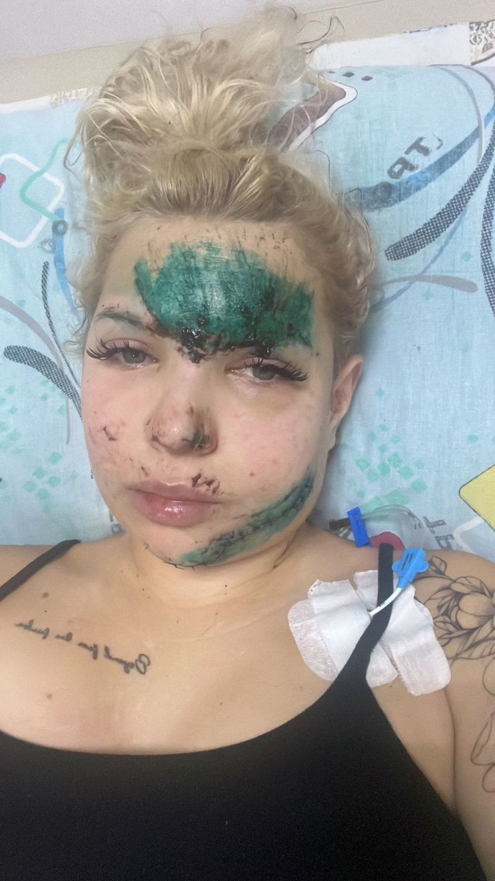 Пострадавшая в ДТП серовчанка поедет на консультацию к врачам. Сбор средств на операцию не закрыт