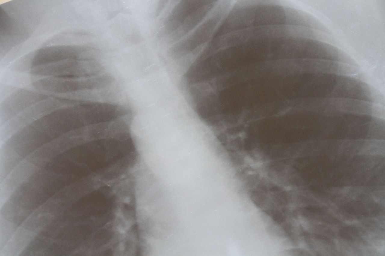 В Серовском горокруге в 2023 году выявлено 49 случаев заболеваний туберкулезом органов дыхания