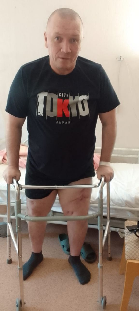 Спустя два с половиной года серовчанин со сложными переломами ног начал вставать
