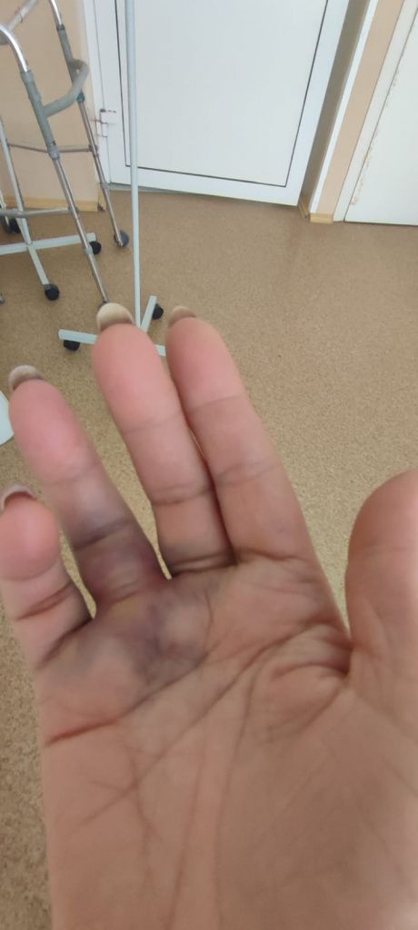 В больнице, по словам серовчанки, рука стала чернеть "на глазах", опухоль стала распространяться по всей руке. Фото предоставлено дочерью пострадавшей пенсионеркой
