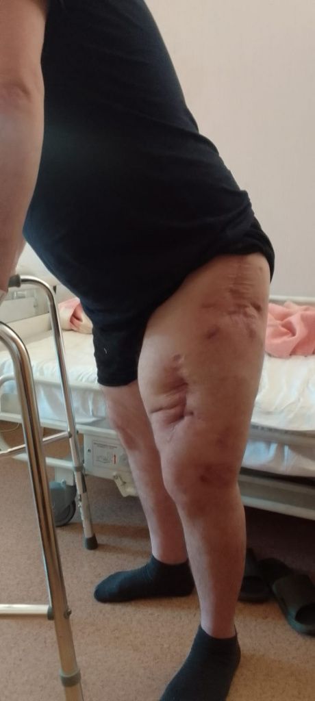 Опухоль на ноге спала, гной больше мужчину не беспокоит. Фото предоставил Александр Кушнерев