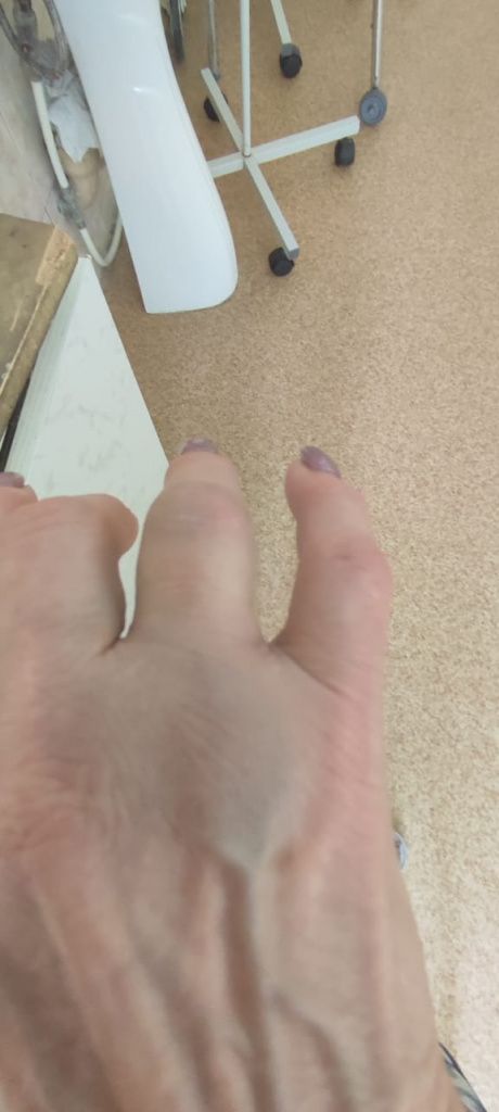 Сначала женщина подумала подумала о том, что просто вывихнула палец. Она успела снять кольцо с руки до того, как палец распух. Фото предоставила дочь пострадавшей пенсионерка