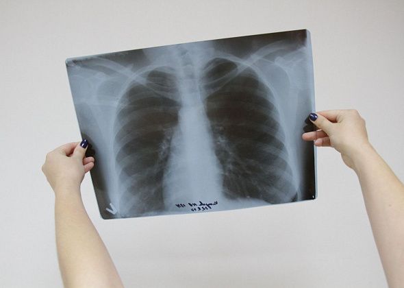 С начала года в Серовском городском округе зарегистрировано 39 случаев заболеваний туберкулезом органов дыхания