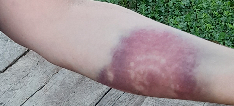 Под суд пошел житель Сосьвы, который поленом сломал руку гражданской супруге и угрожал убить ее