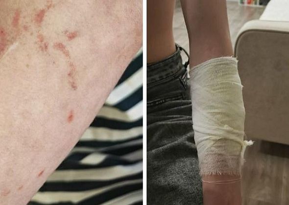 Конфликт между молодежью и серовчанкой закончился ударами поводка и покусанным собакой ребенком