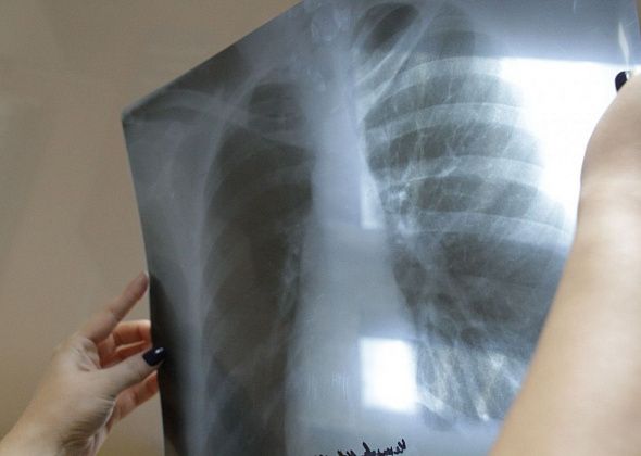 В Серовском горокруге за 10 месяцев выявлен 41 заболевший туберкулезом органов дыхания