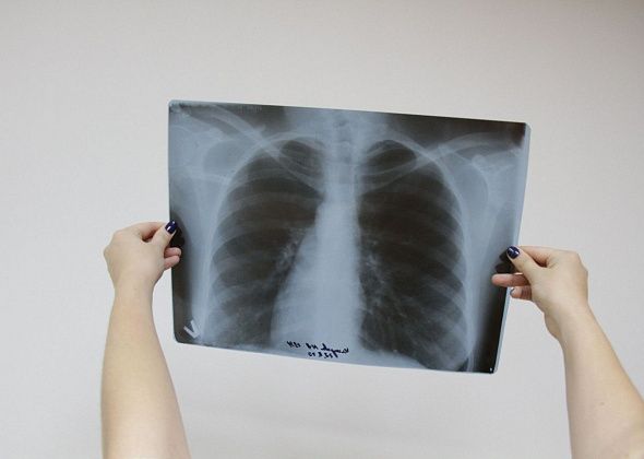 В Серовском горокруге с начала года выявили 30 случаев туберкулеза органов дыхания