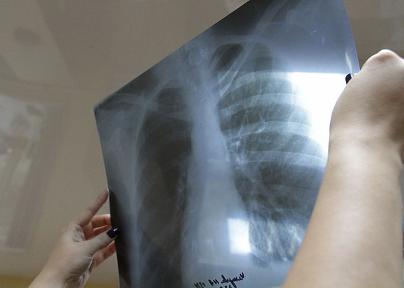 За полгода в Серовском горокруге зарегистрировано 27 заболевших туберкулезом