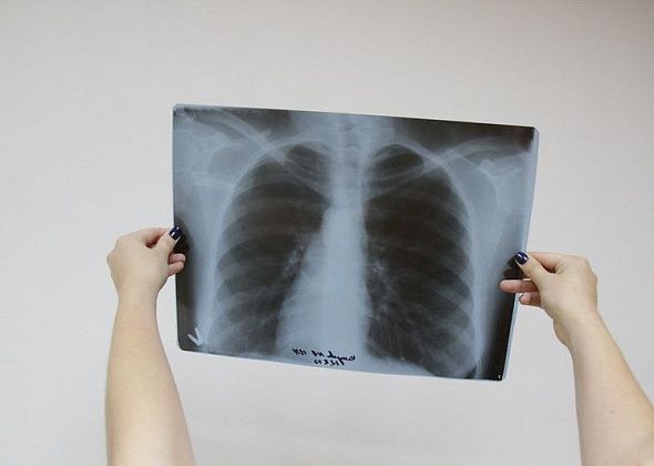 В Серовском горокруге за год зарегистрировано 47 случаев заболевания туберкулезом органов дыхания