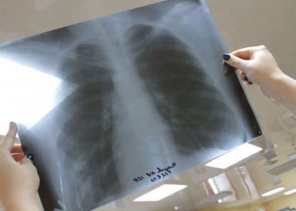 О заболеваемости туберкулезом в Серове, Сосьве и Гарях