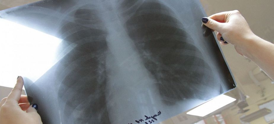 О заболеваемости туберкулезом в Серове, Сосьве и Гарях