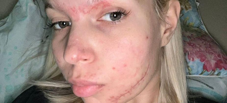 Серовчанка, пострадавшая в ДТП, закрывает сбор средств на лечение. Нужная сумма собрана