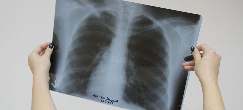 В 2023 году у 6 тысяч свердловчан выявлены патологии легких. В том числе 56 злокачественных образований