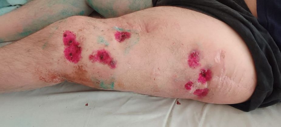 Серовчанина со сложными переломами ног прооперировали в городской больнице